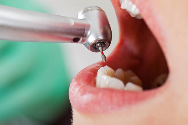 Best Tooth Infection Emergency Dentist  in Des Allemands, LA